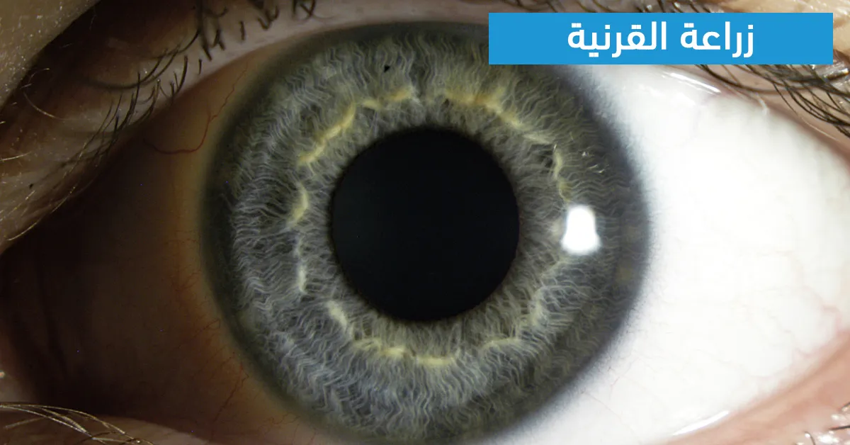 زراعة القرنية